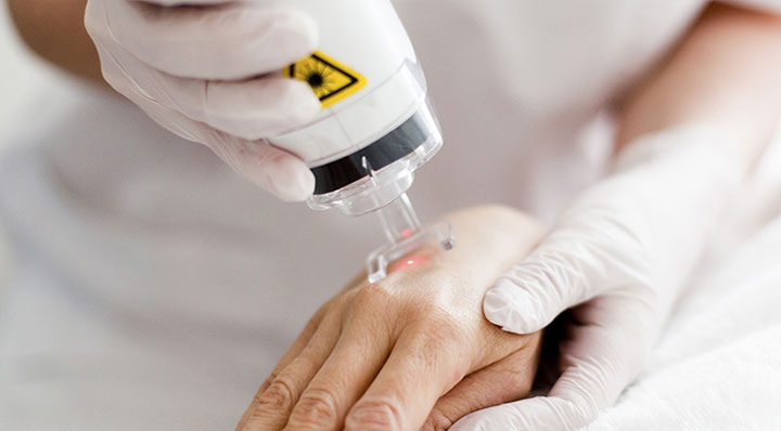 Laser Fraxel Trois-Rivières